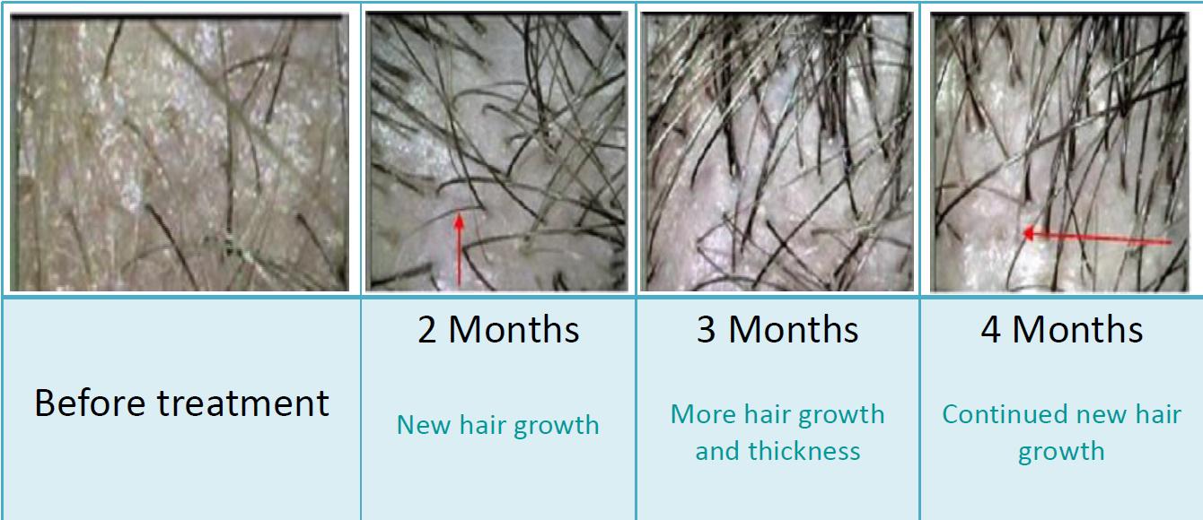 Best Effect Laser Hair Regrowth Machine Best Effect Laser Hair Regrowth Machine