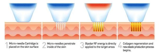 Microneedling Fractional Radiofrequency Device For Treatment Of Acne Scars